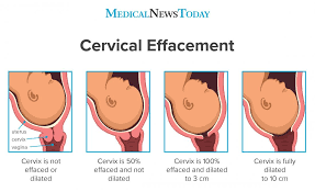Anyway, to perform the cervical check, insert two fingers into the vaginal canal and find the cervix. What To Know About Cervical Effacement Measurements And Diagram