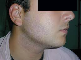 Image result for Postinflammatory Hypopigmentation