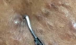 Shop target for women's hair removal products at great prices. Nauseating Video Shows Ingrown Hairs Being Squeezed From A Woman S Bikini Line Daily Mail Online