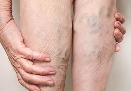 Why Big Blue Varicose Veins Raise A Red Flag Health Essentials From Cleveland Clinic