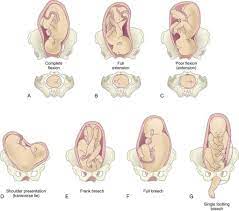 Transverse Baby Babycenter