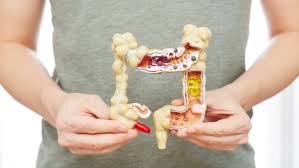 Image result for Constipation in Cancer