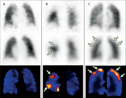 Image result for Ventilation Perfusion Scan