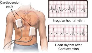 Manual internal defibrillators deliver the shock through paddles placed directly on the heart.1 they are mostly used in the. Common Pitfalls Observed During Acls Certification Exam