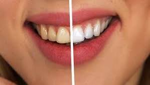 Zähne selber aufhellen mit hausmittel. Zahne Aufhellen Mit Diesen Sechs Tipps Ganz Einfach Von Zu Hause Gesundheit