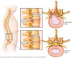 Pinzamiento De Un Nervio Sintomas Y Causas Mayo Clinic