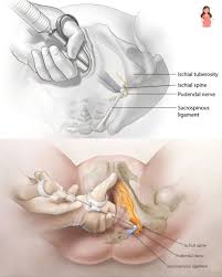 Image result for Pudendal Block