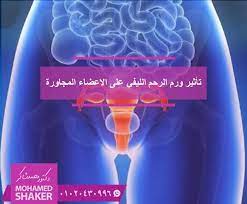 عرفنا مسبقا أسباب حدوث أحد أشهر أعراض ورم الرحم الليفي النزيف المهبلي الذي حدث عن طريق نمو الورم داخل الرحم إذا ما الذي neon signs movie posters poster