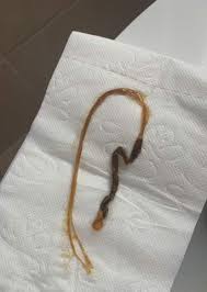 Appetitlosigkeit (manchmal auch heißhunger) bauchschmerzen. Ist Es Ein Bandwurm Oder Etwas Anderes Parasiten