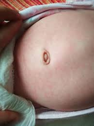 Foliculita se manifesta sub forma de bubite solide care pot fi usturatoare si foarte neplacute. Bubite Corp Bebe Ajutor Desprecopii Com