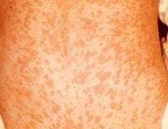 În tarile în curs de dezvoltare (nivel de viata se apreciaza ca peste 1.500.000 de copii mor anual pe glob din cauza rujeolei. Rujeola Pojarul