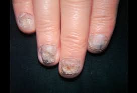 Repeat until your acrylics have completely soaked off. Ringworm Of The Nails Picture Image On Medicinenet Com