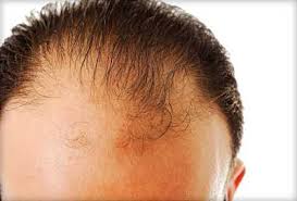 Image result for hair loss definition