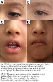 Myasthenia gravis (mg) nadir görülen bir otoimmün bozukluk olup iskelet kaslarının nöromüsküler kavşağında asetilkolin nikotinik postsinaptik reseptörlere karşı antikorların oluştuğu bir hastalıktır. Congenital Myasthenic Syndrome Due To Rapsyn Deficiency A Case Report With A New Mutation And Compound Heterozygosity Medwave