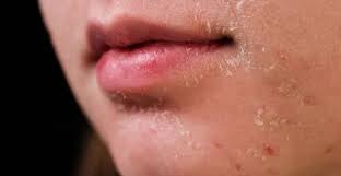 Vì Sao Da Treatment Bị Bong Tróc? Cách Khắc Phục Hiệu Quả | Eucerin
