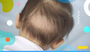 Il mio bambino neonato perde i capelli. Perdita Di Capelli E Alopecia Infantile Cause E Possibili Rimedi Alimentazione Bambini