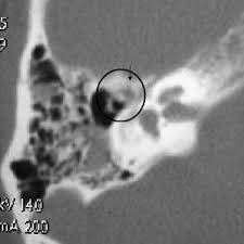 Image result for Ossicular Chain Disruption