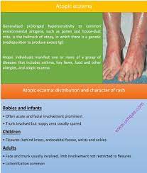 What Are The Diagnostic Criteria For Atopic Eczema Atopic Eczema Eczema Xeroderma