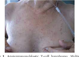 Dirk m elston, md more. Cutaneous Manifestations Of Angioimmunoblastic T Cell Lymphoma Semantic Scholar