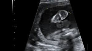 Der kleine trinkt sogar, so dass man die zunge sieht. Organscreening Wird Der Zweite Ultraschall Jetzt Noch Genauer Eltern De