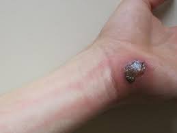 Burn blisters can form over mild to severe burns, and people should try to leave the. Infected Blister Symptoms First Aid Treatment And Healing