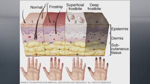 Image result for Frostbite