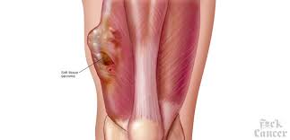 Sarcomas grow in the connective tissues and bones, whereas carcinoma starts on the surface or lining of a body organ. Soft Tissue Sarcoma Awareness