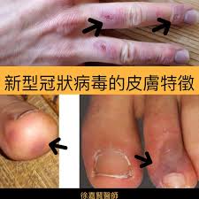 劍橋大學 ravi gupta 教授的研究表明，這種突變在實驗室實驗中使傳染性提高了兩倍，同時使倖存者血液中的抗體攻擊病毒的效率減弱。 變異毒株行為有什麼不同？ 病毒在適應過程中有多種技巧來讓自己更容易傳播。 æˆ'æœ‰æ²'æœ‰å¯èƒ½æ˜¯æ–°å† ç—…æ¯' é†«å¸«ä¸€å¼µåœ–æé†' æ‰‹è…³å‡ºç¾ é€™å€‹ç—‡ç‹€ å¯èƒ½æ˜¯æ—©æœŸå¾µå…† ä»Šå'¨åˆŠ