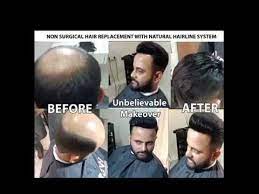 Best Hair Bonding Non Surgical Hair Replacement Services In 1hour Hair E Hair Loss Solutions Hair Replacement Hair Wigs For Men