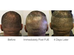 Hair transplants for black women has a greater chance of being successful in just one procedure than most other candidates. Donor Post Fue Hair Transplant Marc Dauer Md Hair Transplant Doctor Los Angeles