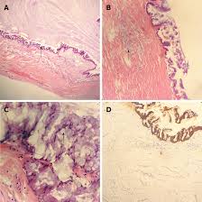 Giant Low Grade Appendiceal Mucinous Neoplasm A Case Report