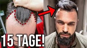 Auch nach der haarverpflanzung sollten sie jemand an ihrer seiten haben, der ihre fragen kompetent beantworten kann. 15 Tage Nach Der Operation Was Kostet Eine Haartransplantation In Istanbul Youtube