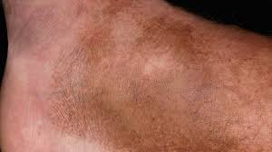 Image result for Pigment stains on the shin