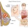 Breast cancer most commonly spreads to the bones, liver, lungs, and brain. 1