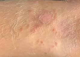 Image result for Impetigo