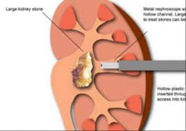 Laser Treatment Of Kidney Stone In Jaipur Sanganer By Dr Sanjay Mittal Id 18748563091