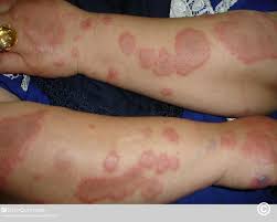Image result for Erythema Multiforme Major