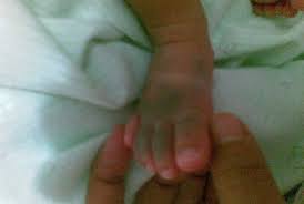 Tanda lahir pada dibagi menjadi beberapa jenis tanda lahir berdasarkan bentuk tanda lahir dan warna tanda lahir. Inilah 15 Makna Tanda Lahir