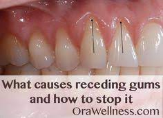 What Causes Receding Gums And How To Stop It Orawellness Gum Disease Treatment Receding Gums Teeth Health