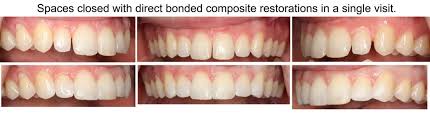 Like regular dental bonding, teeth bonding uses a composite resin customized to fit the color of your natural teeth. Dental Boding Before After Photos Smile Makeovers Boynton Beach Fl