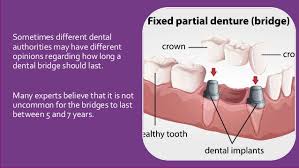 Your natural teeth are supposed to last a lifetime, but there are extenuating circumstances that make that highly unlikely for many people. How Long Will A Dental Bridge Last