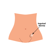 Image result for Inguinal hernia child