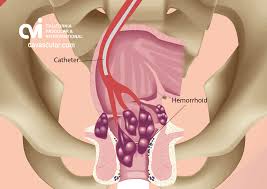 Image result for hemoroid human