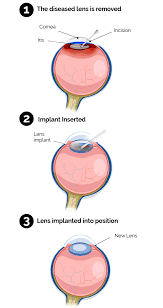 Image result for Cataract Extraction