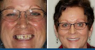 This results in dentures that look more natural in your mouth. How Much Do Dentures Cost Aesthetic Dental Center 701 214 5552