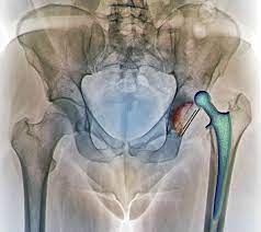 Check spelling or type a new query. Dislocation Of A Hip Replacement Implant