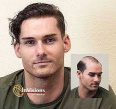 Treatment of male and female pattern hair loss // j. What Are The Warning Signs Of Male Pattern Baldness Hair Loss Restoration Replacement Connecticut