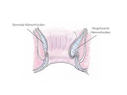 Bei hämorrhoiden handelt es sich um den plexus hämorrhoidalis superior (corpus cavernosum recti), ein der kontinenz dienendes, arteriovenöses gefäßpolster oral der linea dentata des analkanals.werden hämorrhoiden klinisch auffällig, spricht man von einem hämorrhoidalleiden.es handelt sich um ein häufiges krankheitsbild, dessen symptomatik sich durch anale blutungen. Hamorrhoiden