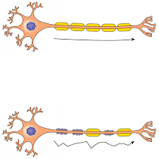 La esclerosis múltiple (ms) es una enfermedad del sistema nervioso central que afecta al balance, al movimiento y a la visión. Multiple Sclerosis Institut Guttmann