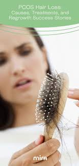 PCOS Hair Loss